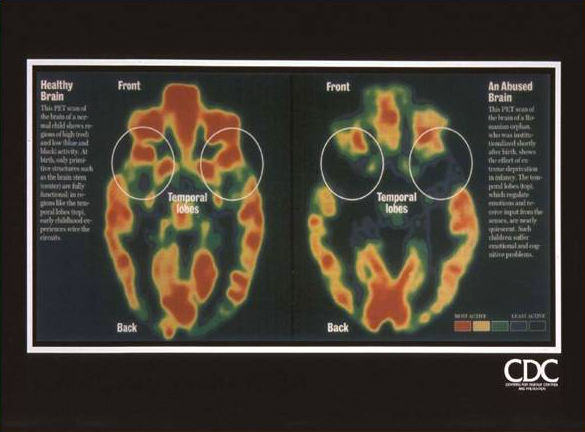 Brain scan of two people, one healthy and one who has suffered abuse